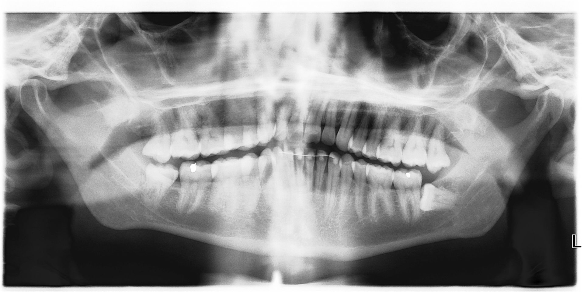 Meddlesome Molars Wisdom Tooth Removal Springfield Dental Group